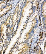 HEXA antibody. IHC(P): Human Intestinal Cancer Tissue.