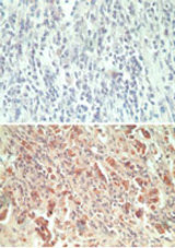 IHC ofGPR18 in paraffin-embedded formalin-fixed human breast tumor tissue using an isotype control (top) and LS-C148364 (bottom) at 5 ug/ml.