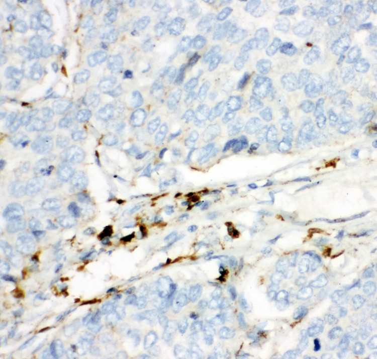 HEXB antibody IHC-paraffin: Human Lung Cancer Tissue.