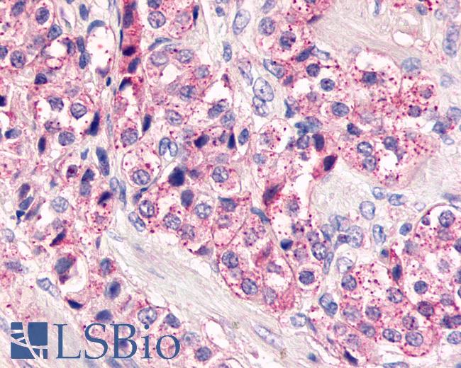 Anti-GPCRW / GPR18 antibody IHC of human Prostate, Carcinoma. Immunohistochemistry of formalin-fixed, paraffin-embedded tissue after heat-induced antigen retrieval.