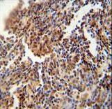 HFM1 antibody immunohistochemistry of formalin-fixed and paraffin-embedded human lung carcinoma followed by peroxidase-conjugated secondary antibody and DAB staining.