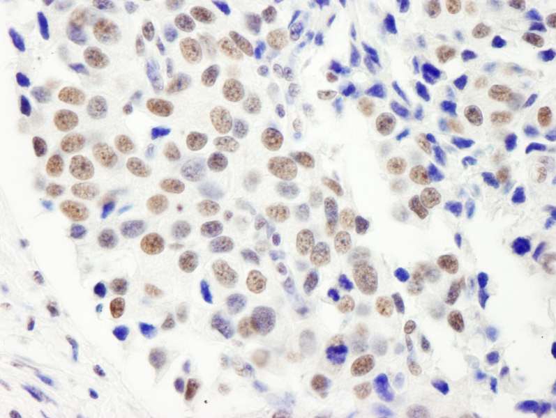 Detection of Human FIP1 by Immunohistochemistry. Sample: FFPE section of human breast carcinoma. Antibody: Affinity purified rabbit anti-FIP1 used at a dilution of 1:5000 (0.2 Detection: DAB.
