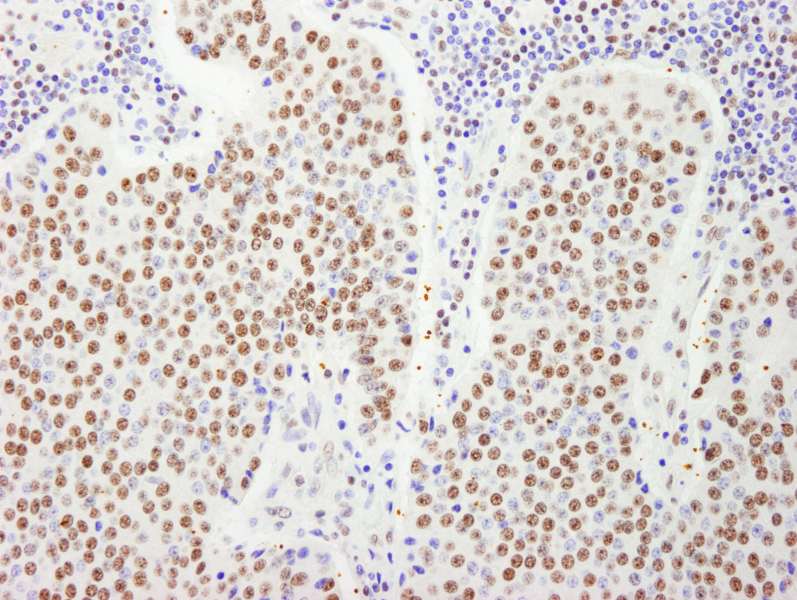 Detection of Human FIP1 by Immunohistochemistry. Sample: FFPE section of human pancreatic islet cell tumor. Antibody: Affinity purified rabbit anti-FIP1 used at a dilution of 1:1000 (1 Detection: DAB.