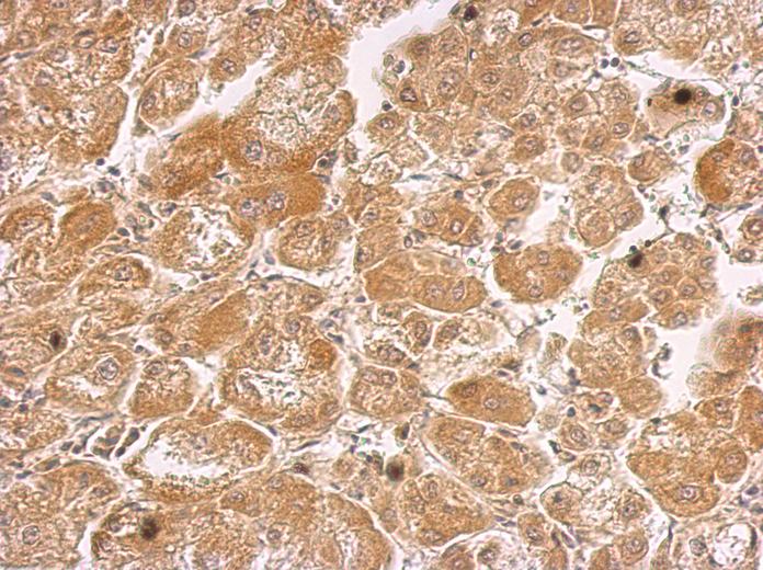 HHIP antibody [N3C2], Internal detects HHIP protein at cytosol on hepatoma by immunohistochemical analysis. Sample: Paraffin-embedded hepatoma. HHIP antibody [N3C2], Internal dilution:1:500.