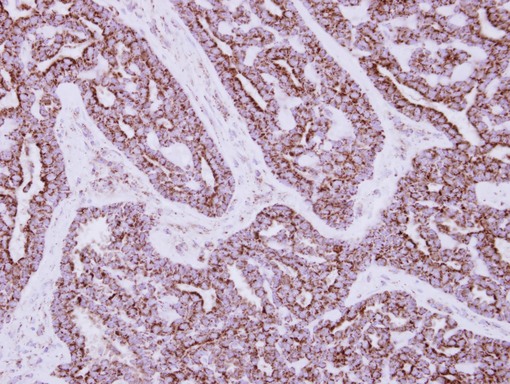 IHC of paraffin-embedded Breast ca, using HIBADH antibody at 1:250 dilution.