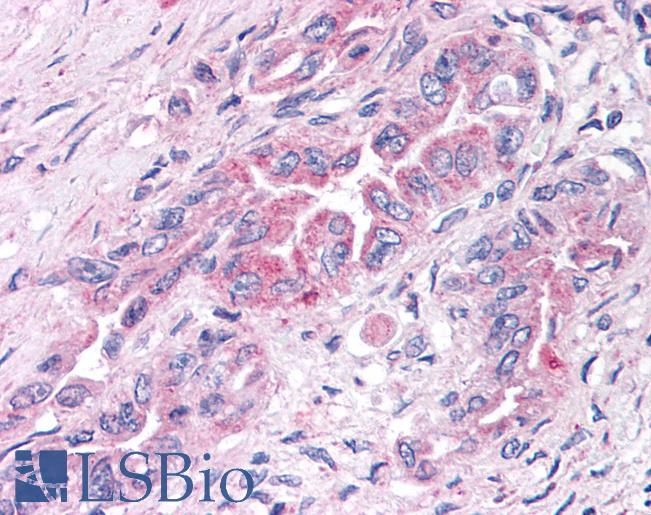 Anti-GPER1 / GPR30 antibody IHC of human Pancreas, Carcinoma. Immunohistochemistry of formalin-fixed, paraffin-embedded tissue after heat-induced antigen retrieval.