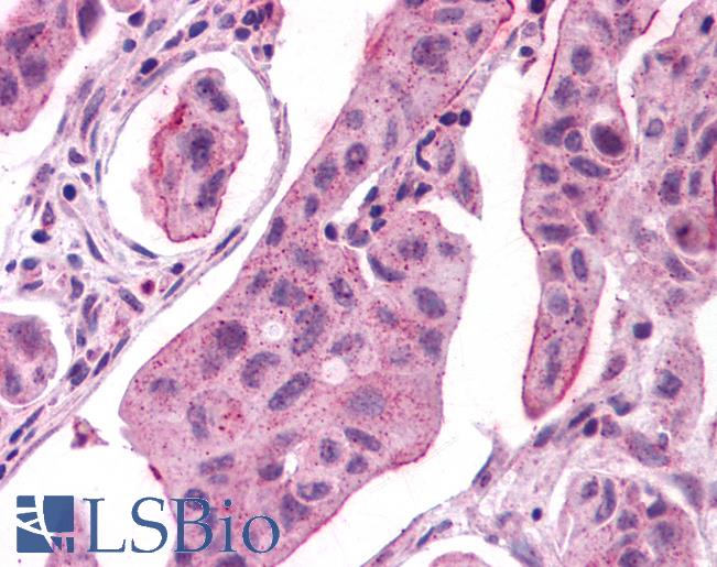 Anti-GPER1 / GPR30 antibody IHC of human Breast, Carcinoma. Immunohistochemistry of formalin-fixed, paraffin-embedded tissue after heat-induced antigen retrieval.