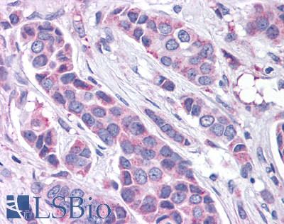 Anti-GPR30 antibody LS-A4290 IHC of human breast carcinoma. Immunohistochemistry of formalin-fixed, paraffin-embedded tissue after heat-induced antigen retrieval.