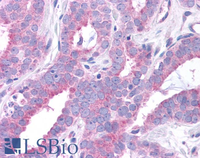 Anti-GPER1 / GPR30 antibody IHC of human Prostate, Carcinoma. Immunohistochemistry of formalin-fixed, paraffin-embedded tissue after heat-induced antigen retrieval.
