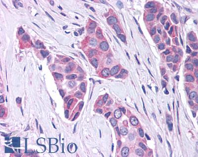 Anti-GPR30 antibody LS-A4272 IHC of human breast carcinoma. Immunohistochemistry of formalin-fixed, paraffin-embedded tissue after heat-induced antigen retrieval.