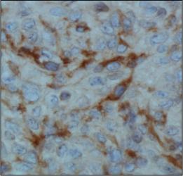 Factor Inhibiting HIF-1 Antibody (162c) - IHC of FIH in human renal cancer using DAB with hematoxylin counterstain.