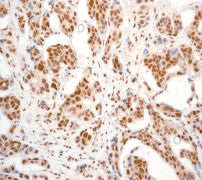IHC of paraffin-embedded human breast carcinoma tissue using anti-FIH1 antibody (LS-C105594).