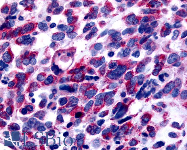 Anti-GPER1 / GPR30 antibody IHC of human Skin, Melanoma. Immunohistochemistry of formalin-fixed, paraffin-embedded tissue after heat-induced antigen retrieval.