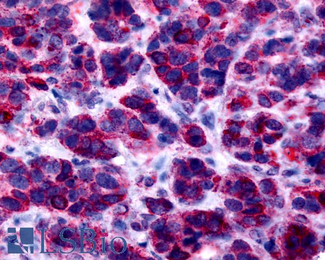 Anti-GPER1 / GPR30 antibody IHC of human breast, carcinoma. Immunohistochemistry of formalin-fixed, paraffin-embedded tissue after heat-induced antigen retrieval.
