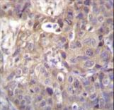 HIPK1 Antibody immunohistochemistry of formalin-fixed and paraffin-embedded human breast carcinoma followed by peroxidase-conjugated secondary antibody and DAB staining.