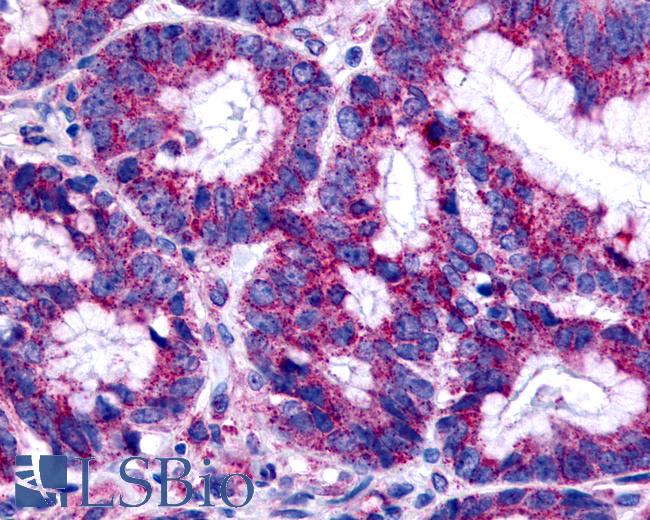 Anti-GPER1 / GPR30 antibody IHC of human colon, carcinoma. Immunohistochemistry of formalin-fixed, paraffin-embedded tissue after heat-induced antigen retrieval.