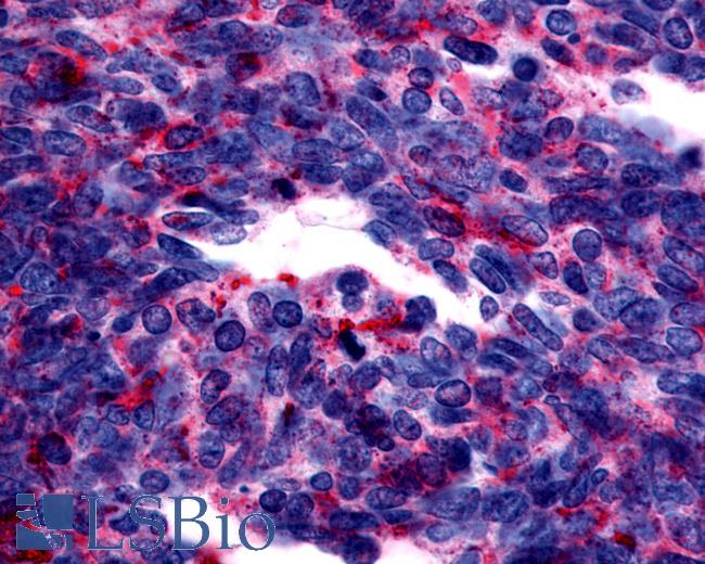 Anti-GPER1 / GPR30 antibody IHC of human Lung, Small Cell Carcinoma. Immunohistochemistry of formalin-fixed, paraffin-embedded tissue after heat-induced antigen retrieval.