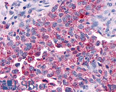 Anti-GPR30 antibody LS-A1184 IHC of human breast carcinoma. Immunohistochemistry of formalin-fixed, paraffin-embedded tissue after heat-induced antigen retrieval.