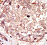 Formalin-fixed and paraffin-embedded human cancer tissue reacted with the primary antibody, which was peroxidase-conjugated to the secondary antibody, followed by DAB staining. This data demonstrates the use of this antibody for immunohistochemistry; clinical relevance has not been evaluated. BC = breast carcinoma; HC = hepatocarcinoma.