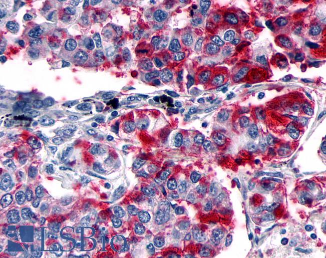 Anti-GPER1 / GPR30 antibody IHC of human Lung, Non-Small Cell Carcinoma. Immunohistochemistry of formalin-fixed, paraffin-embedded tissue after heat-induced antigen retrieval.
