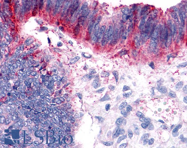 Anti-GPER1 / GPR30 antibody IHC of human Colon, Carcinoma. Immunohistochemistry of formalin-fixed, paraffin-embedded tissue after heat-induced antigen retrieval.