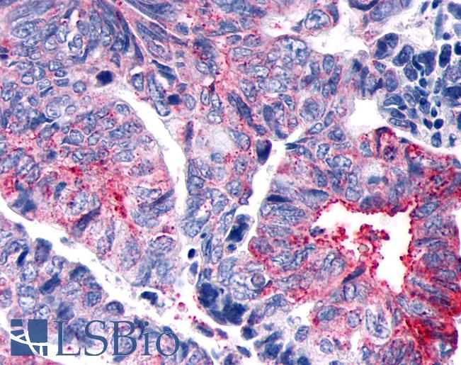 Anti-GPER1 / GPR30 antibody IHC of human Colon, Carcinoma. Immunohistochemistry of formalin-fixed, paraffin-embedded tissue after heat-induced antigen retrieval.