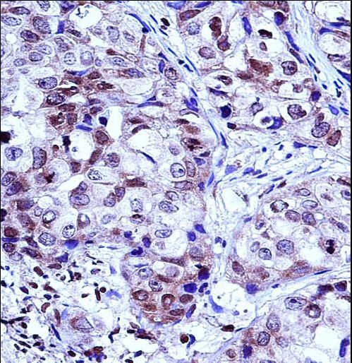 HIST1H1D Antibody immunohistochemistry of formalin-fixed and paraffin-embedded human breast carcinoma followed by peroxidase-conjugated secondary antibody and DAB staining.