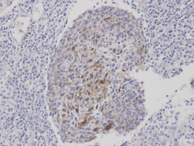 IHC of paraffin-embedded gastric CA using CLCA1 antibody at 1:100 dilution.