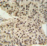HIST1H2AL Antibody IHC of formalin-fixed and paraffin-embedded human lung carcinoma followed by peroxidase-conjugated secondary antibody and DAB staining. This data demonstrates the use of the HIST1H2AL Antibody for immunohistochemistry.