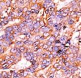 Formalin-fixed and paraffin-embedded human cancer tissue reacted with the primary antibody, which was peroxidase-conjugated to the secondary antibody, followed by AEC staining. This data demonstrates the use of this antibody for immunohistochemistry; clinical relevance has not been evaluated. BC = breast carcinoma; HC = hepatocarcinoma.