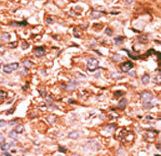 Formalin-fixed and paraffin-embedded human cancer tissue reacted with the primary antibody, which was peroxidase-conjugated to the secondary antibody, followed by AEC staining. This data demonstrates the use of this antibody for immunohistochemistry; clinical relevance has not been evaluated. BC = breast carcinoma; HC = hepatocarcinoma.