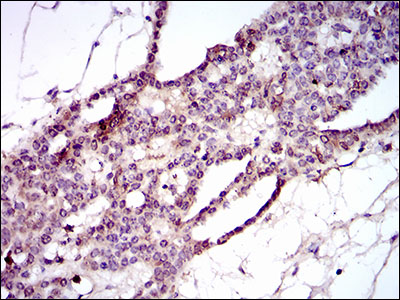 IHC of paraffin-embedded ovarian cancer tissues using PIWIL4 mouse monoclonal antibody with DAB staining.