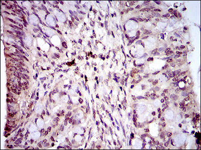 IHC of paraffin-embedded rectum cancer tissues using PIWIL4 mouse monoclonal antibody with DAB staining.