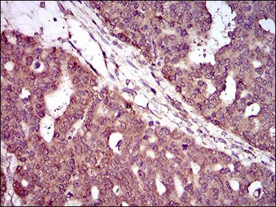 IHC of paraffin-embedded ovarian cancer tissues using PIWIL4 mouse monoclonal antibody with DAB staining.