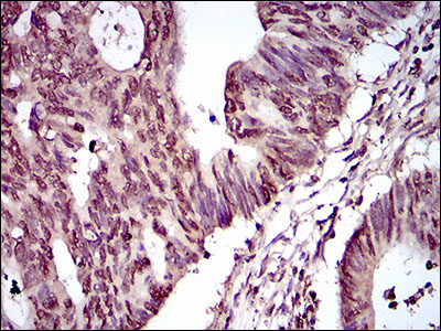 IHC of paraffin-embedded rectum cancer tissues using PIWIL4 mouse monoclonal antibody with DAB staining.