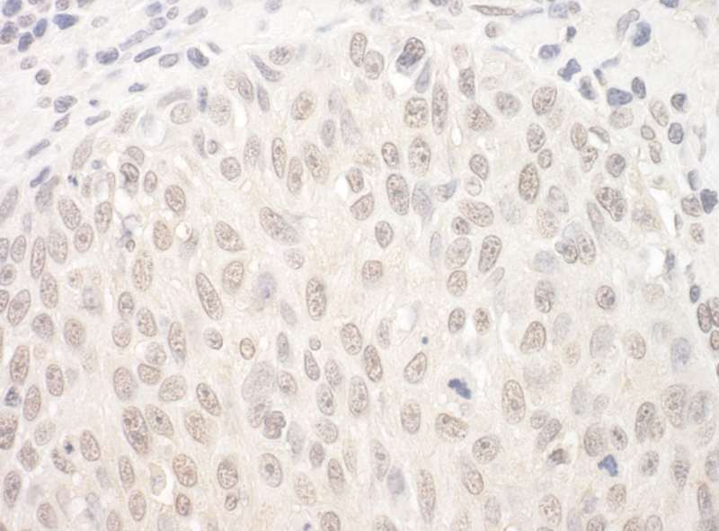 Detection of Human HJURP by Immunohistochemistry. Sample: FFPE section of human skin carcinoma. Antibody: Affinity purified rabbit anti-HJURP used at a dilution of 1:1000 (1 ug/mg).