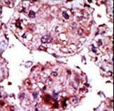 Formalin-fixed and paraffin-embedded human cancer tissue reacted with the primary antibody, which was peroxidase-conjugated to the secondary antibody, followed by AEC staining. This data demonstrates the use of this antibody for immunohistochemistry; clinical relevance has not been evaluated. BC = breast carcinoma; HC = hepatocarcinoma.