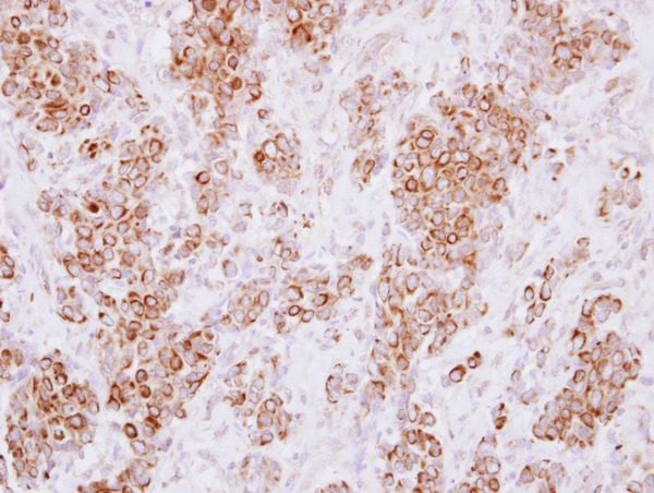 IHC of paraffin-embedded Breast ca using HLA-DMA antibody at 1:250 dilution.