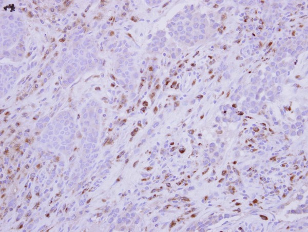 IHC of paraffin-embedded TUMOR-INFILTRATED LEUKOCYTES, using HLA-DMA antibody at 1:500 dilution.