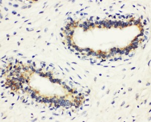 HLA-DMB antibody. IHC(P): Human Breast Cancer Tissue.