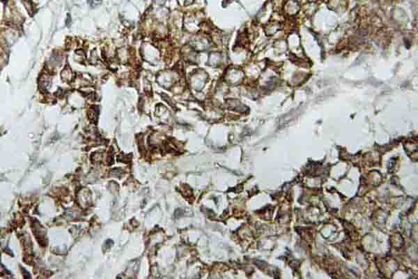 IHC of HLA-DO (V111) pAb in paraffin-embedded human breast carcinoma tissue.