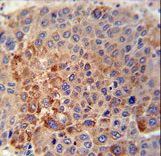 GPLD1 Antibody immunohistochemistry of formalin-fixed and paraffin-embedded human hepatocarcinoma tissue followed by peroxidase-conjugated secondary antibody and DAB staining.