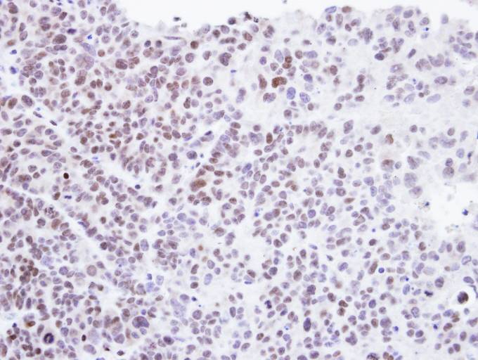 IHC of paraffin-embedded SW480 xenograft using Homeobox-containing protein 1 antibody at 1:500 dilution.