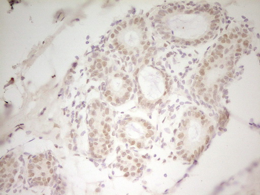IHC of paraffin-embedded Adenocarcinoma of Human breast tissue using anti-HMG20A mouse monoclonal antibody. (Heat-induced epitope retrieval by 1 mM EDTA in 10mM Tris, pH8.5, 120°C for 3min).