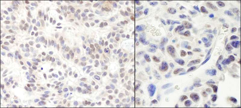Detection of Human and Mouse HMG2a by Immunohistochemistry. Sample: FFPE section of human skin basal cell carcinoma (left) and mouse squamous cell carcinoma (right). Antibody: Affinity purified rabbit anti-HMG2a used at a dilution of 1:200 (1 Detection: DAB.