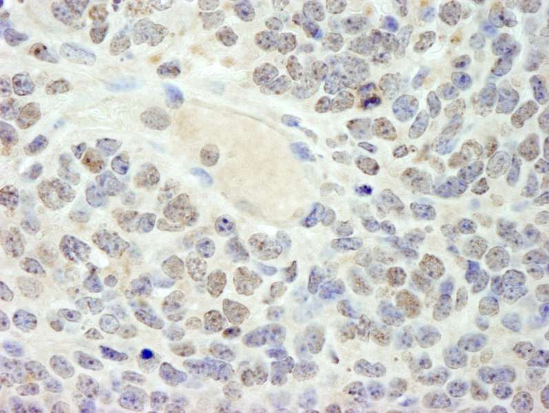 Detection of Mouse HMG2a by Immunohistochemistry. Sample: FFPE section of mouse teratoma. Antibody: Affinity purified rabbit anti-HMG2a used at a dilution of 1:250.