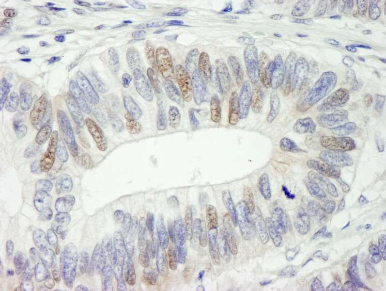 Detection of Human HMG2a by Immunohistochemistry. Sample: FFPE section of human colon adenocarcinoma. Antibody: Affinity purified rabbit anti-HMG2a used at a dilution of 1:250.