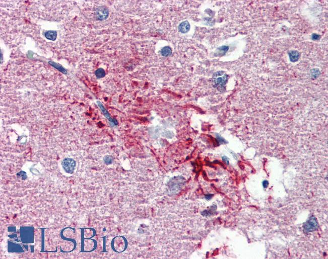 Anti-HMGN1 antibody IHC of human brain, cortex, senile plaque. Immunohistochemistry of formalin-fixed, paraffin-embedded tissue after heat-induced antigen retrieval. Antibody LS-B3496 concentration 5 ug/ml.