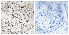 IHC of paraffin-embedded human breast carcinoma, using HMG14 (Phospho-Ser21) Antibody. The sample on the right was incubated with synthetic peptide.