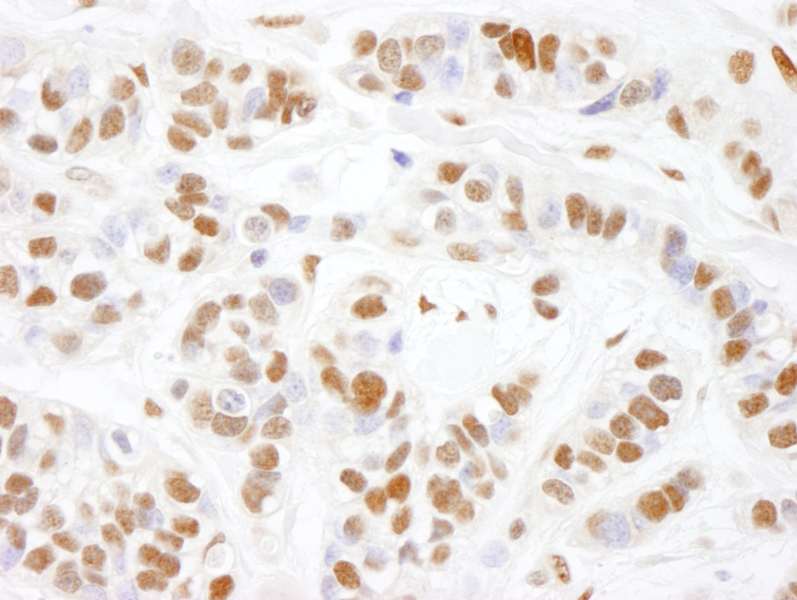 Detection of Human HMGN1 by Immunohistochemistry. Sample: FFPE section of human breast carcinoma. Antibody: Affinity purified rabbit anti-HMGN1 used at a dilution of 1:1000 (1 Detection: DAB.